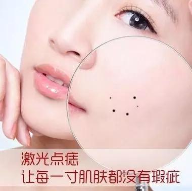 美容院激光祛痣仪器